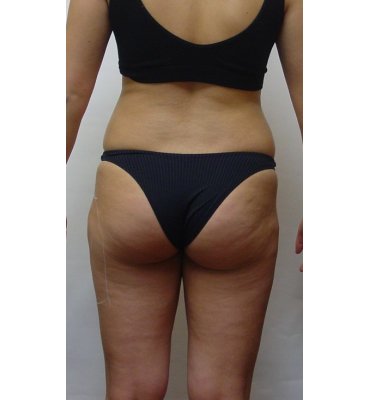 liposuction before 